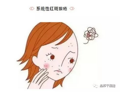 干细胞 系统性红斑狼疮