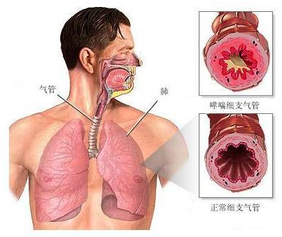 干细胞是 哮喘病难以 的金钥匙！