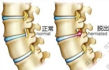 腰椎间盘突出