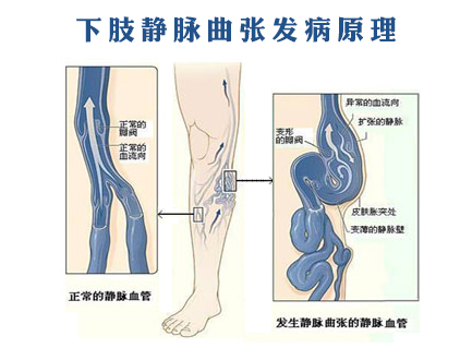 静脉曲张