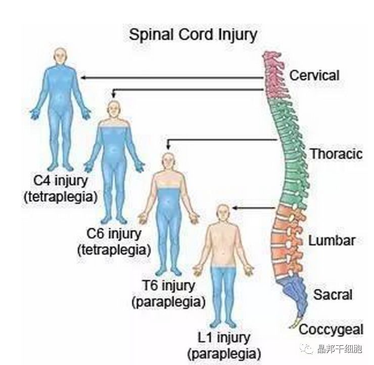 干细胞让脊髓损伤患者重新站起来不是梦！